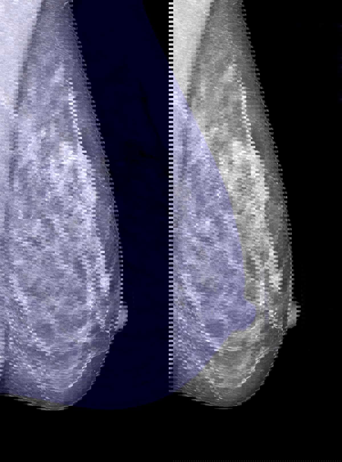 breast x-ray mammogram