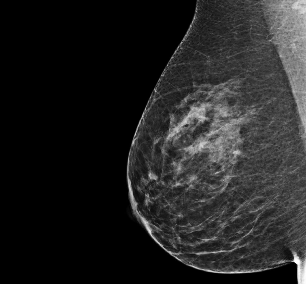 A mammogram image of category B breast tissue